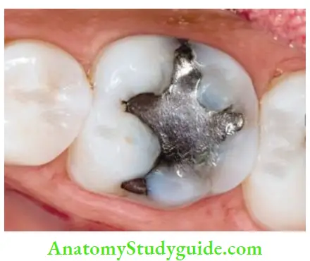 Restoration Of Endodontically Treated Teeth Molar with suffient tooth structure can be restored using crown.