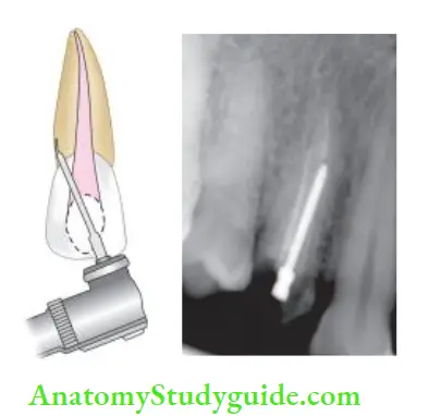 Restoration Of Endodontically Treated Teeth Perforation due to misdirection of drill;Perforation of root space due to misdirection of drills while preparing post space.