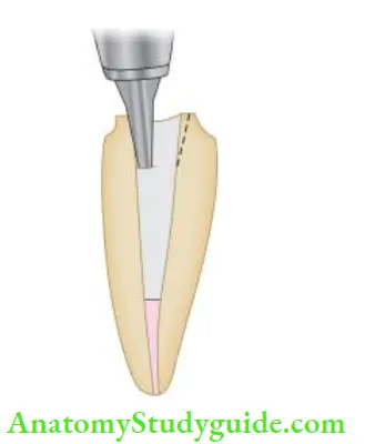 Restoration Of Endodontically Treated Teeth Place antirotational notch with the help of cylindrical diamond bur.