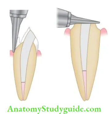 Restoration Of Endodontically Treated Teeth Preparation of tooth structure. Removal of unsupported tooth structure
