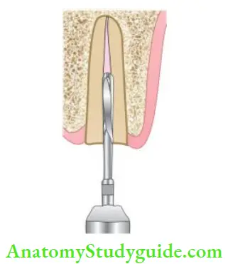 Restoration Of Endodontically Treated Teeth Removal of gutta-percha using peeso reamer.