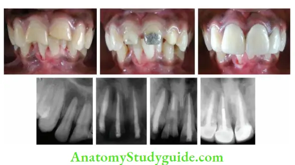 Restoration Of Endodontically Treated Teeth Restoration of left maxillary central incisor by using cast post and core