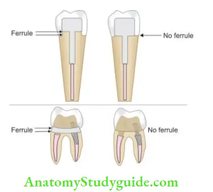 Restoration Of Endodontically Treated Teeth Schematic representation of ferrule effct of- Anterior teeth; Posterior teeth.