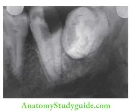Restoration Of Endodontically Treated Teeth Weakening of tooth structure due to caries.