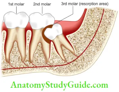 Root Resorption External Inflmmatory Root Resorption Resulting Due To Pressure Exerted By Impacted 3rd Molar