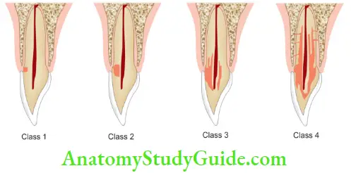 Root Resorption Heithersay's Classification Of Cervical Root Resorption
