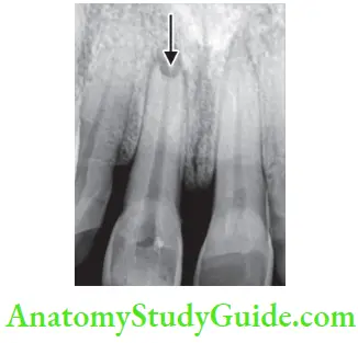 Root Resorption Radiograph Showing Apical Root Resorption In Maxillary Central Incisor