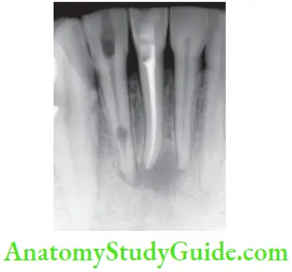 Root Resorption Radiograph Showing Oval Radiolucent Enlargement Of Pulp Space In Mandibular Lateral Incisor With Imteral Resorption