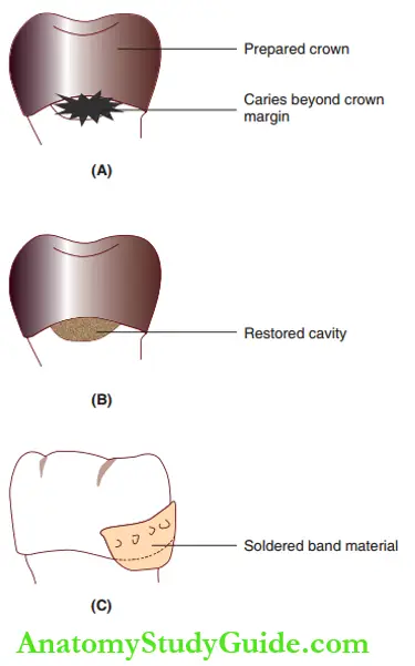Semi Permanent Restorations Dental Caries Beyond The Crown
