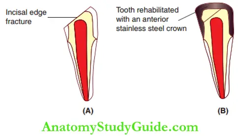 Semi Permanent Restorations En Masse Cuspal Fracture Of Primary Teeth