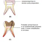 Semi Permanent Restorations Pupectomised Or Pilpotomised Primary And Permanent Molars