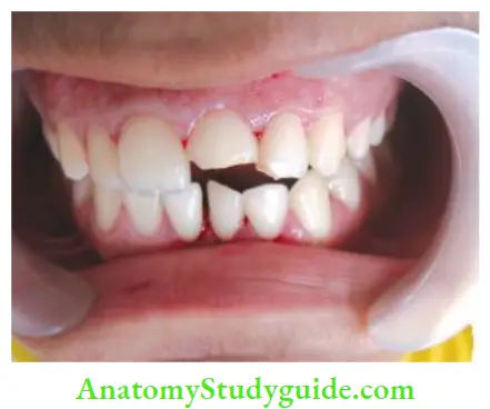 Single Visit Endodontics In anterior teeth, single-visit endodontic therapy is indicated because of esthetic reasons.