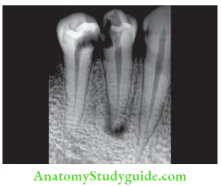 Single Visit Endodontics Nonvital mandibular first premolar with periapical pathology is not indicated for single-visit endodontics