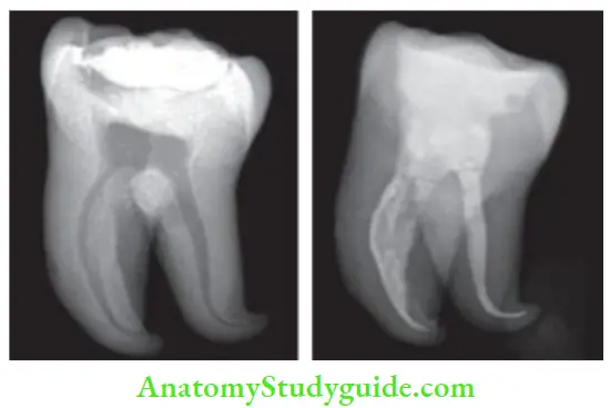 Single Visit Endodontics Root canal treatment of Mandibular molar with curved canals is not a good choice for single visit endodontics