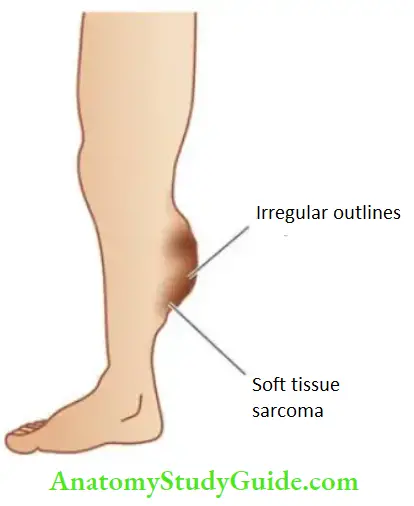 Soft Tissue Tumours Fibrosarcoma, common clinical location