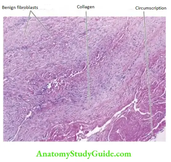 Soft Tissue Tumours Palmar fibromatosis.