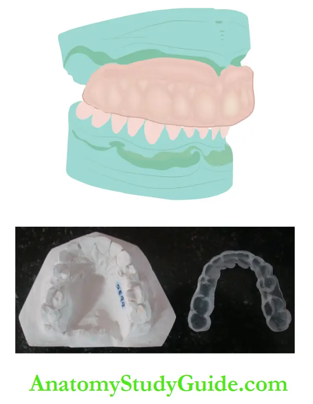 Sports Dentistry Custom-fabricated mouthguard