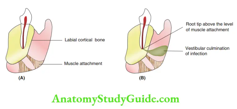 Spread Of Dentoalveolar Mandibular canine without infection Spread of dentoalveolar infection from a mandibular canine.