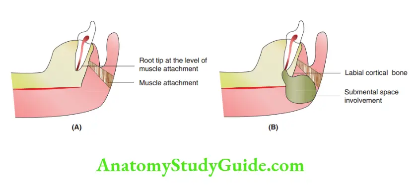 Spread Of Dentoalveolar Mandibular incisor without infection. Spread of dentoalveolar infection from a mandibular central incisor