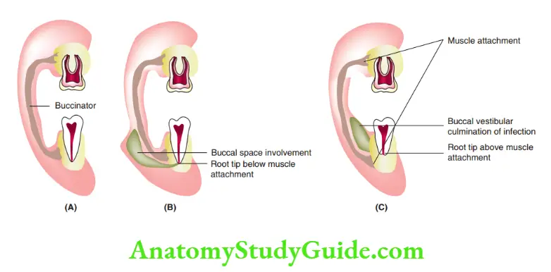 Spread Of Dentoalveolar Mandibular molar without infection Spread of dentoalveolar infection from mandibular molars buccally when the