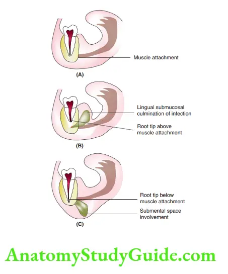 Spread Of Dentoalveolar Mandibular molar without infection.