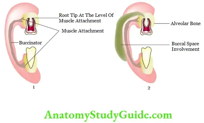 Spread Of Dentoalveolar Maxillary molar without infection Spread of dentoalveolar infection from a maxillary molar