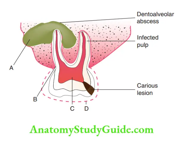 Spread Of Dentoalveolar Methods of drainage of dentoalveolar abscess in a molar tooth