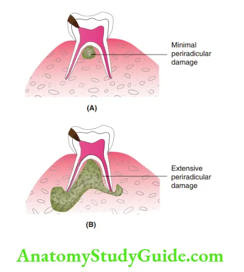 Spread Of Dentoalveolar Two pulpally involved teeth with dentoalveolar