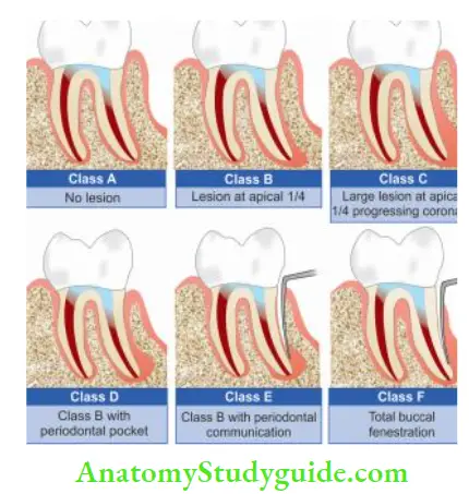 Surgical Endodontics Classifiation of endodontic microsurgical cases.