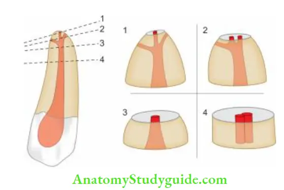 Surgical Endodontics Diagram showing root resection at diffrent levels. Figure shows that root resection of 3 mm at 0° bevel, eliminates most of the anatomic features.
