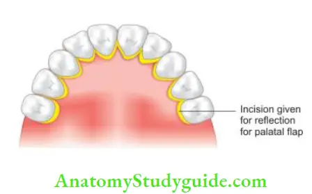 Surgical Endodontics Flap for palatal surgery.