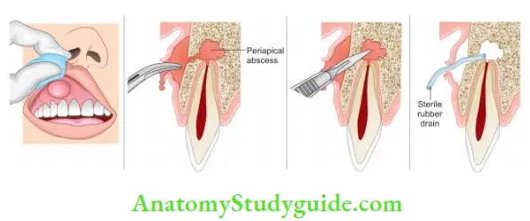 Surgical Endodontics Incision and Drainage