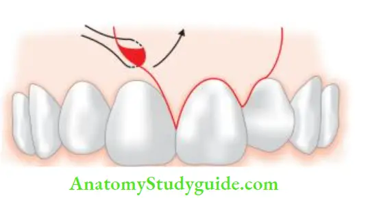 Surgical Endodontics Lifting of mucoperiosteum.