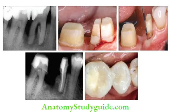 Surgical Endodontics Management of mandibular fist molar by hemisection-Pre-Operative radiograph; Hemisection of fist molar; Post-surgical radiograph; Postsurgical photograph.