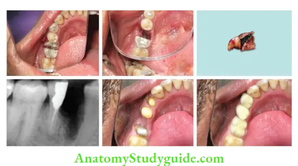 Surgical Endodontics Management of mandibular fist molar by hemisection