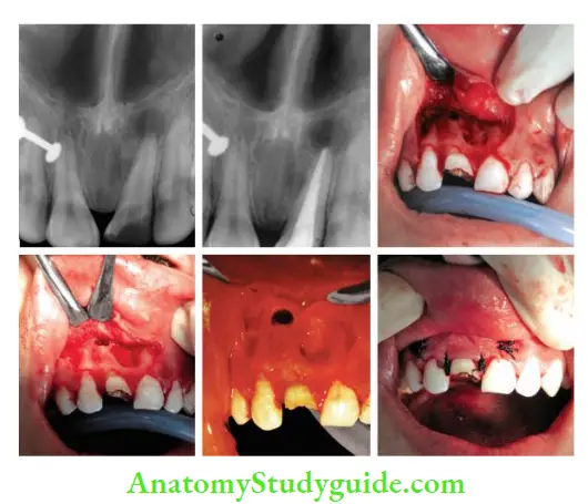 Surgical Endodontics Management of right maxillary central incisor with periapical radiolucency by periapical curettage