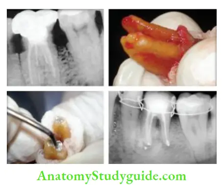 Surgical Endodontics Management of separated instrument in mandibular fist molar by intentional replantation