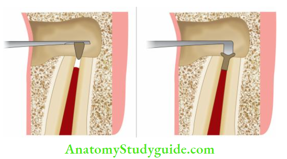 Surgical Endodontics Placement of restorative material;Removal of excess material.