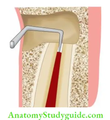 Surgical Endodontics Retrograde cavity preparation using ultrasonic handpiece.