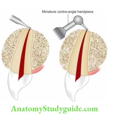 Surgical Endodontics Root-end preparation using straight handpiece; Root-end preparation using handpiece.