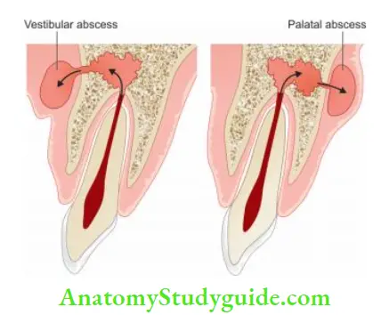 Surgical Endodontics Surgical drainage is indicated if purulent exudate forms within the soft tissue or the alveolar bone.