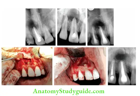 Surgical Endodontics Surgical management of periapical cyst in relation to 21