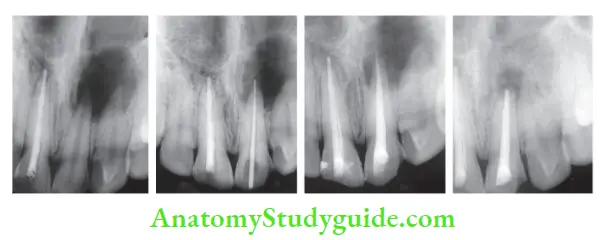 Surgical Endodontics Surgical treatment of maxillary left central incisor with periapical lesion