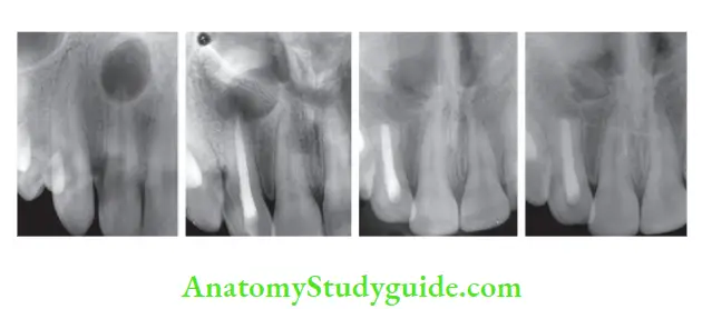 Surgical Endodontics Surgical treatment of maxillary right lateral incisor with periapical lesion
