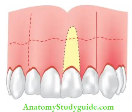 Surgical Endodontics Triangular flap.