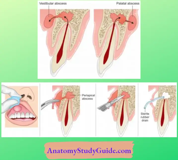 Surgical Incision And  Surgical Drainage