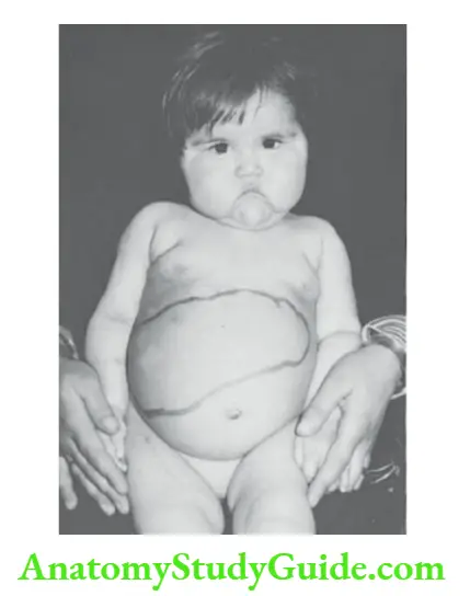 The Alimentary System and Abdomen Glycogen storage disease. Note typical doll-like facies and massive hepatomegaly
