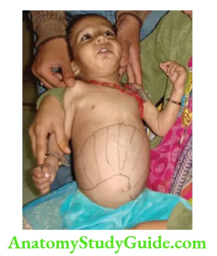 The Alimentary System and Abdomen Massive hepatomegaly in an infant with Gaucher’s disease