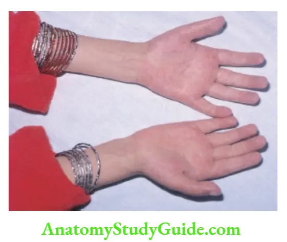 The Alimentary System and Abdomen Palmar erythema due to hepatocellular failure.