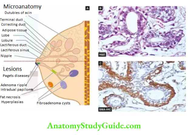 The Breast A, Microanatomy of the breast and major lesions at various sites. B, Normal terminal duct lobular unit (TDLU). C,